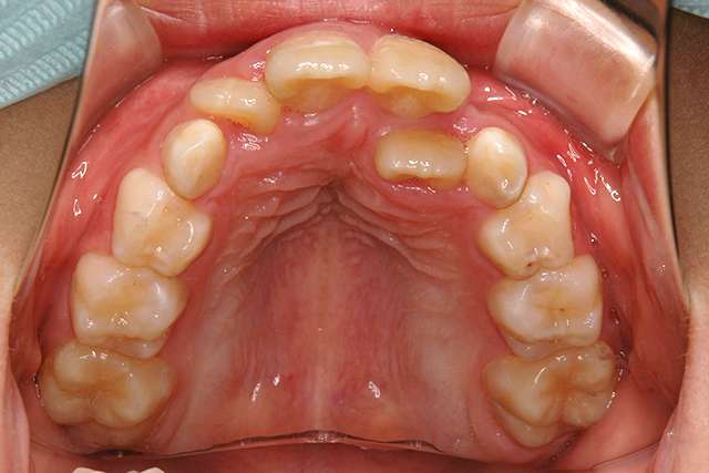 口呼吸は絶対ダメ 口呼吸の原因と治し方 久野歯科医院